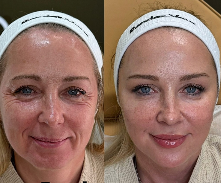 Botox, fillers, skin boosters - 1 session